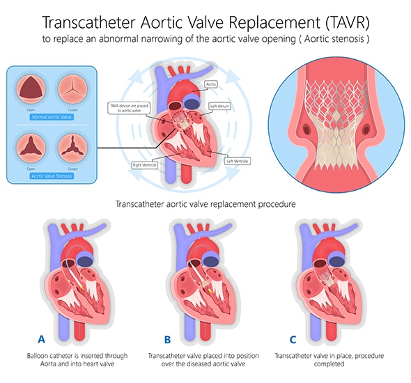 TAVR procedure