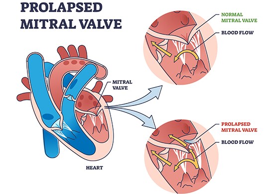 Prolapsed Mitral Valve