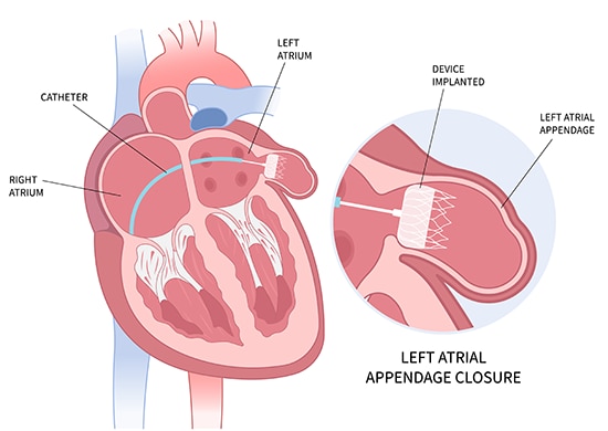 Left Atrial Appendage Occlusion for AFib| Monterey, CA | Montage Health